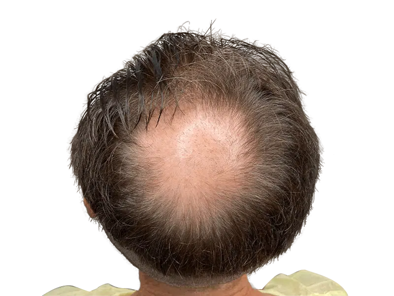 Thinning hair & receding hairline. Hair loss before hair restoration treatment. Could be a candidate for hair transplant.