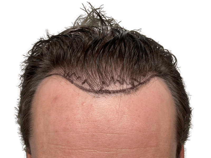 Hair transplant result: Improved hairline with denser, fuller hair. Before/after visible on forehead. Hair restoration success.