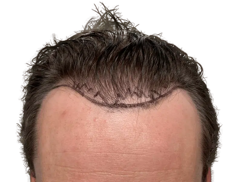 Hair transplant result: Improved hairline with denser, fuller hair. Before/after visible on forehead. Hair restoration success.