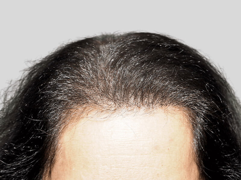 Hair transplant result: Dense, dark hair along a smooth, scar-free hairline. Successful hair restoration for a natural, youthful look.