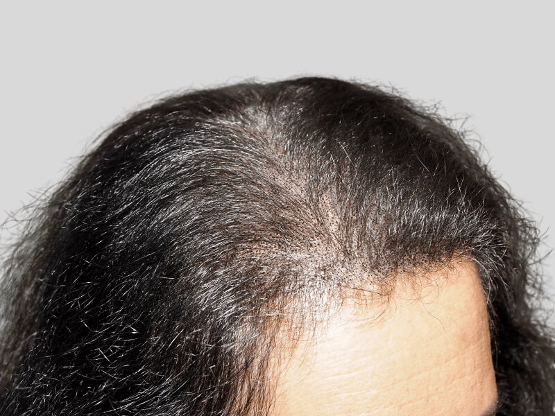 Hair transplant close-up: Improved hairline density on Hispanic/African American patient. Before/after hair restoration results visible.