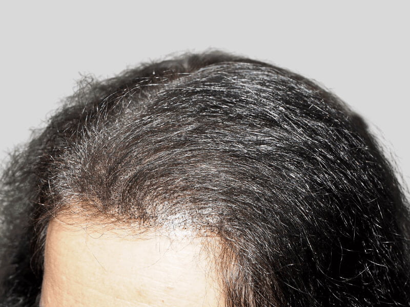 Hair transplant before & after. Restored hairline on African American/Hispanic man. Hair restoration results.