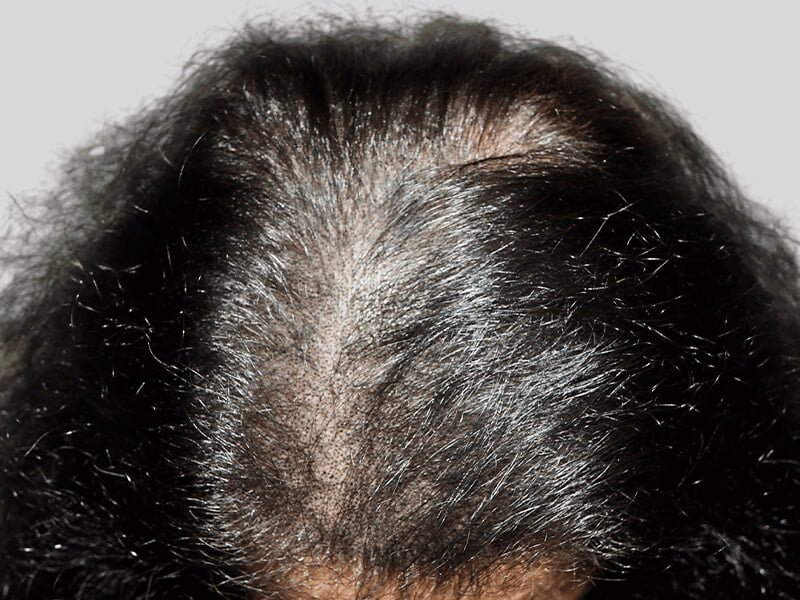 Hair thinning at crown. Possible hair transplant before/after. Hair restoration options for receding hairline.