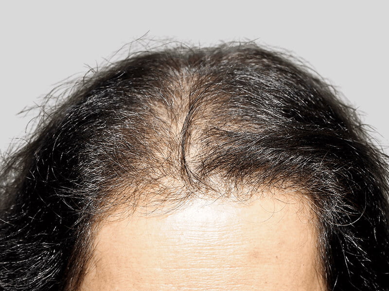 Thinning dark hair at crown & hairline. Hair loss before hair restoration treatment. Caucasian male.