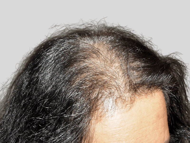 Thinning dark hair on scalp. Hair loss before hair restoration or transplant. Potential before & after result.