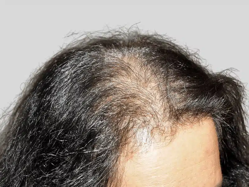 Thinning dark hair on scalp. Hair loss before hair restoration or transplant. Potential before & after result.