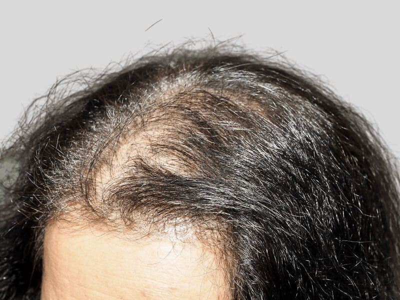 Thinning dark hair on scalp. Potential hair loss candidate. Consider hair restoration or transplant options.