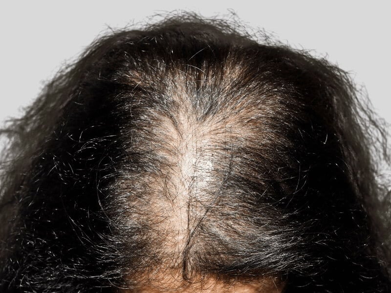 Thinning dark hair at the crown. Potential hair loss candidate. Consider hair restoration options or a hair transplant.