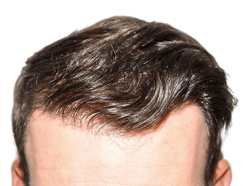 Hair transplant result: Dense, natural hairline restoration. Dark brown hair, improved density. Before/after available.