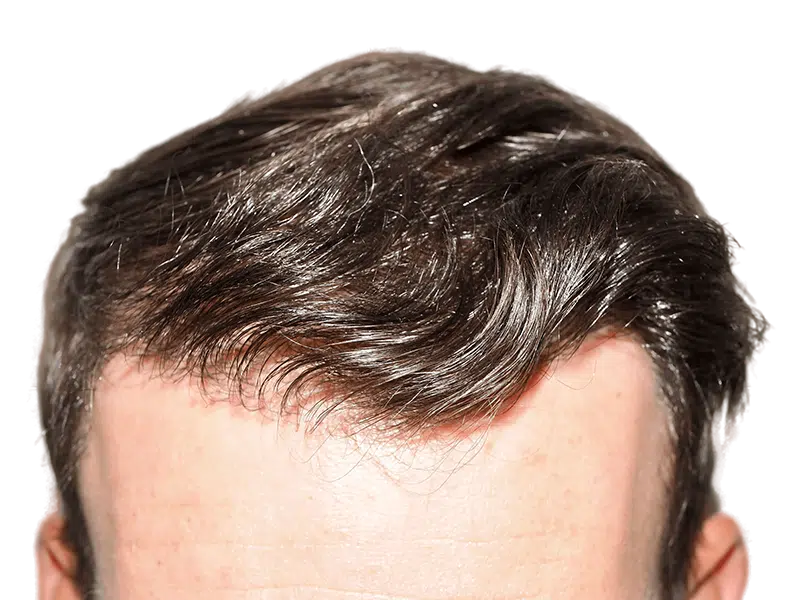 Hair transplant result: Dense, natural hairline restoration. Dark brown hair, improved density. Before/after available.