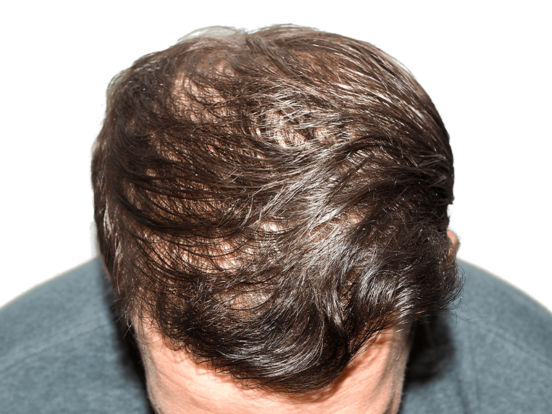 Thinning brown hair on scalp. Potential hair loss candidate. Consider hair restoration or transplant options.