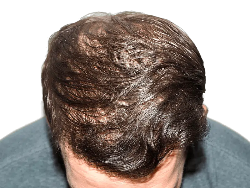 Thinning brown hair on scalp. Potential hair loss candidate. Consider hair restoration or transplant options.