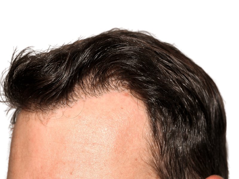 Receding hairline. Potential hair transplant candidate. Hair restoration before/after example. Dark hair, Caucasian male.