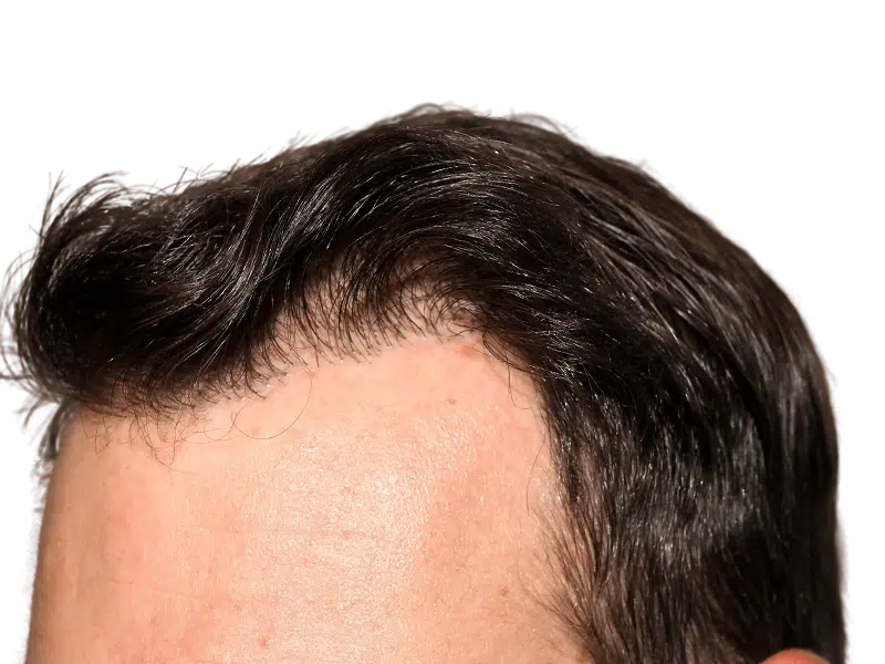 Receding hairline. Potential hair transplant candidate. Hair restoration before/after example. Dark hair, Caucasian male.