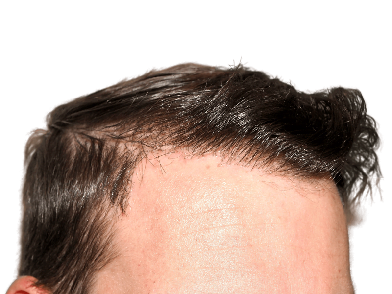 Hair transplant result: Dense, natural hairline achieved. Before & after hair restoration example. Male with dark brown hair.