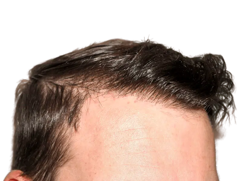 Hair transplant result: Dense, natural hairline achieved. Before & after hair restoration example. Male with dark brown hair.