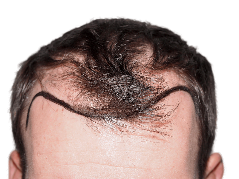 Hair transplant planning: Marked hairline on thinning hair. Before hair restoration procedure. Caucasian male.