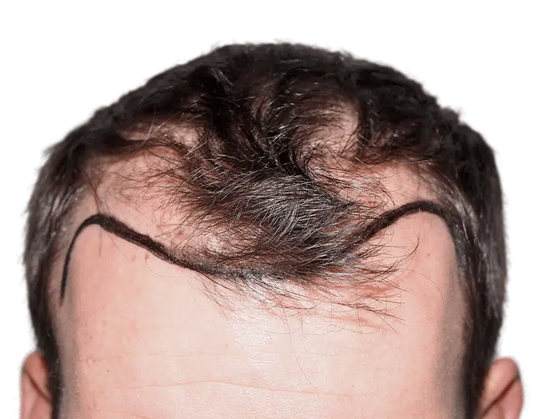 Hair transplant planning: Marked hairline on thinning hair. Before hair restoration procedure. Caucasian male.