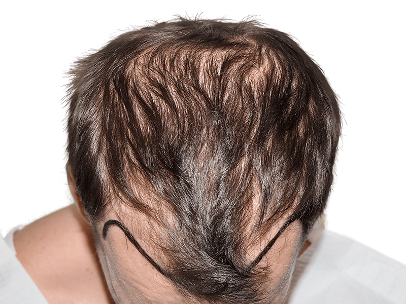 Before hair transplant: Thinning dark brown hair with marked receding hairline. Hair restoration candidate.