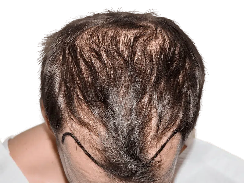 Before hair transplant: Thinning dark brown hair with marked receding hairline. Hair restoration candidate.