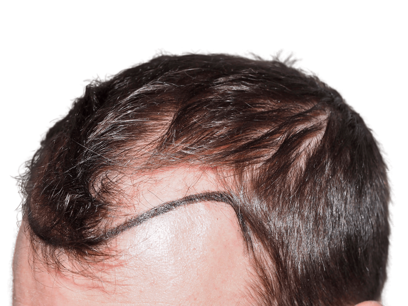 Hair transplant before: Thinning hairline marked for restoration. Dark brown hair, fair skin. Hair loss treatment concept.