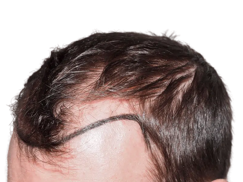 Hair transplant before: Thinning hairline marked for restoration. Dark brown hair, fair skin. Hair loss treatment concept.