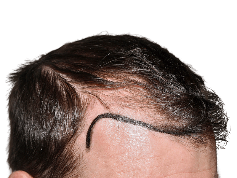 Hair transplant planning: Marked hairline before procedure. Dark brown hair, thinning. Hair restoration consultation.