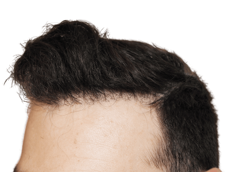 Hair transplant result: Close-up of restored hairline. Dark hair, fair skin. Demonstrates density and natural placement after procedure.