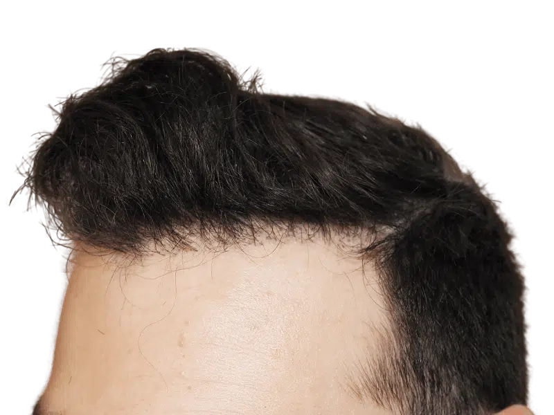 Hair transplant result: Close-up of restored hairline. Dark hair, fair skin. Demonstrates density and natural placement after procedure.