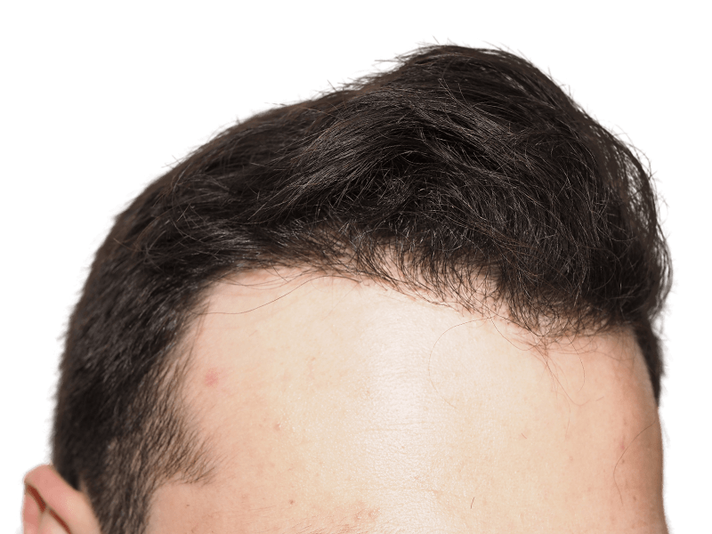 Receding hairline before hair transplant. Male with thinning dark hair. Hair restoration candidate.