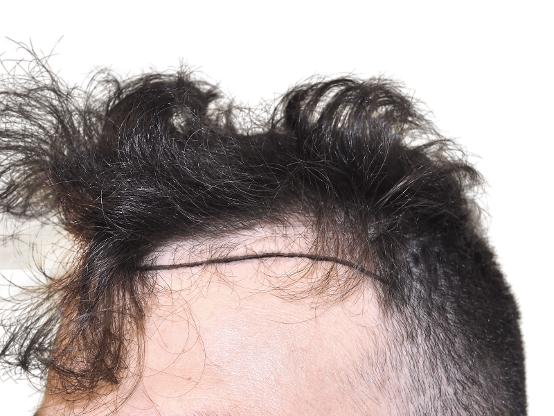 Hair transplant scar on hairline. Close-up of dark, curly hair after restoration procedure. Potential before/after result.