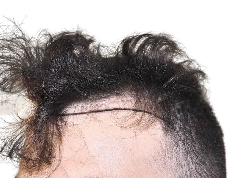 Hair transplant scar on hairline. Close-up of dark, curly hair after restoration procedure. Potential before/after result.