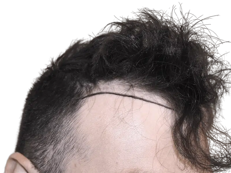 Hair transplant result: Natural hairline restoration on Caucasian male. Before & after hair growth visible.