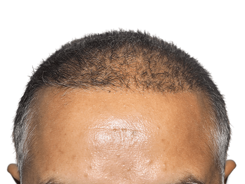 Receding hairline before hair transplant. Thinning dark hair, likely Hispanic/Middle Eastern man. Hair restoration candidate.