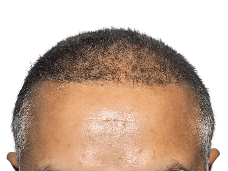 Receding hairline before hair transplant. Thinning dark hair, likely Hispanic/Middle Eastern man. Hair restoration candidate.