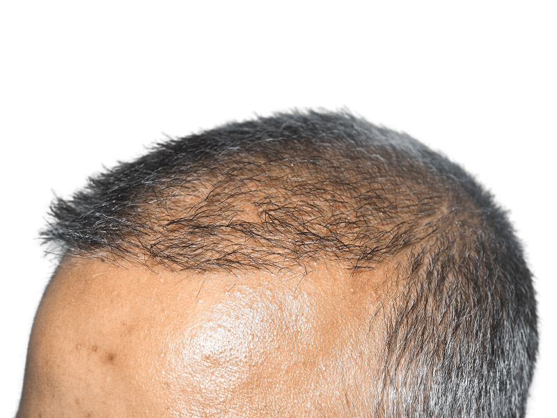 Receding hairline close-up. Asian male. Potential hair transplant before/after. Hair restoration services.