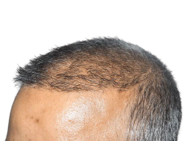 Receding hairline close-up. Asian male. Potential hair transplant before/after. Hair restoration services.