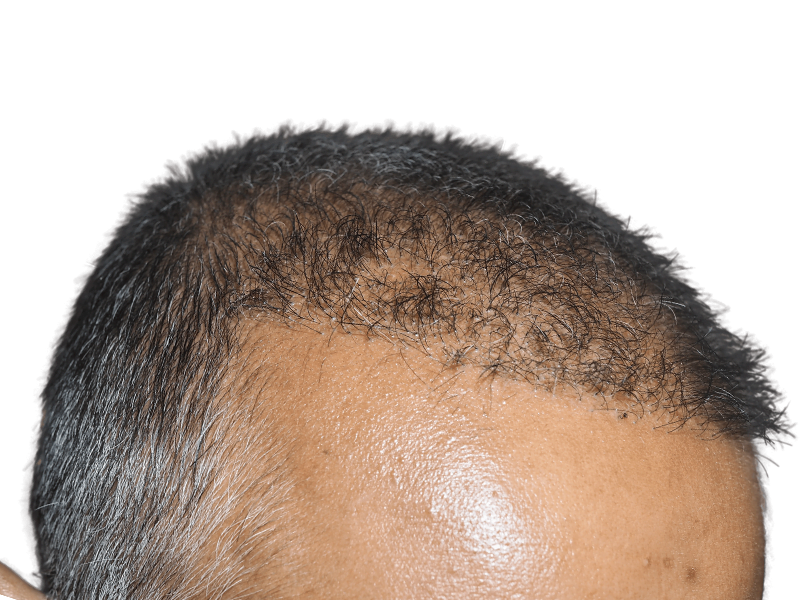 Hair transplant results: Before (thinning hairline) & after (fuller, restored hair). Effective hair restoration procedure.