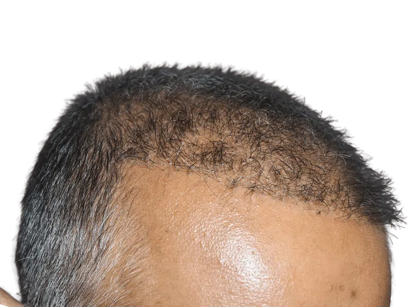 Hair transplant results: Before (thinning hairline) & after (fuller, restored hair). Effective hair restoration procedure.