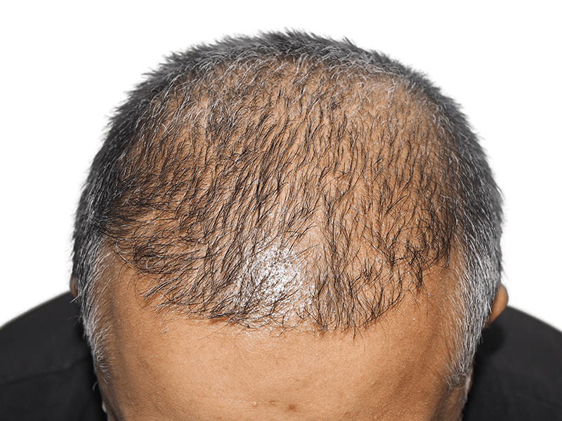 Balding head: thinning hair, likely before hair restoration. Hair transplant candidate. Gray and dark hair mix.