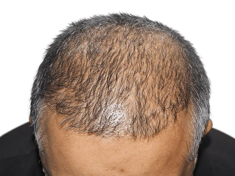 Balding head: thinning hair, likely before hair restoration. Hair transplant candidate. Gray and dark hair mix.