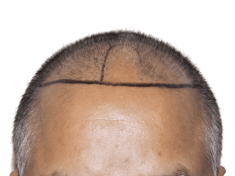 Before hair transplant: Receding hairline marked for restoration. Asian/Middle Eastern descent. Hair restoration services.