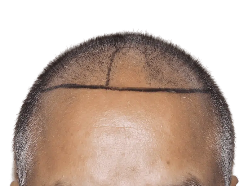 Before hair transplant: Receding hairline marked for restoration. Asian/Middle Eastern descent. Hair restoration services.