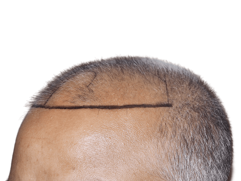 Before hair transplant: Asian man with receding hairline marked for hair restoration. Thinning hair, potential procedure.