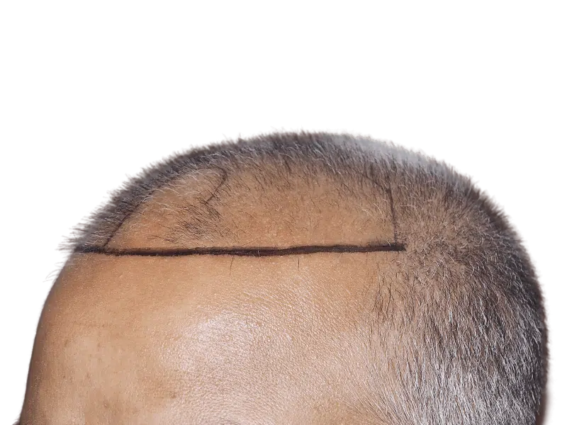 Before hair transplant: Asian man with receding hairline marked for hair restoration. Thinning hair, potential procedure.