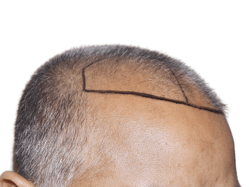 Before hair transplant: Thinning, graying hair marked for restoration. Illustrates hairline design for hair loss treatment.