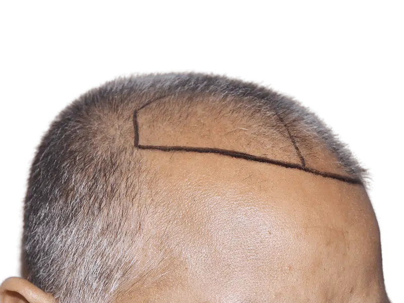 Before hair transplant: Thinning, graying hair marked for restoration. Illustrates hairline design for hair loss treatment.
