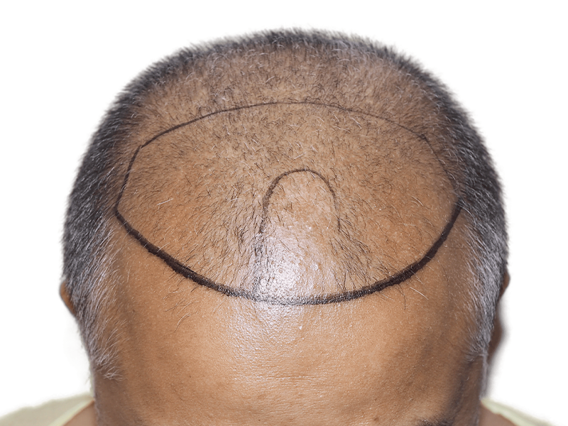 Hair transplant planning: Marked scalp shows hair loss area. Potential hair restoration for thinning crown and receding hairline.