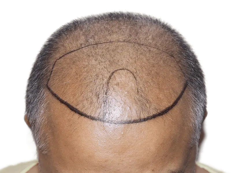 Hair transplant planning: Marked scalp shows hair loss area. Potential hair restoration for thinning crown and receding hairline.
