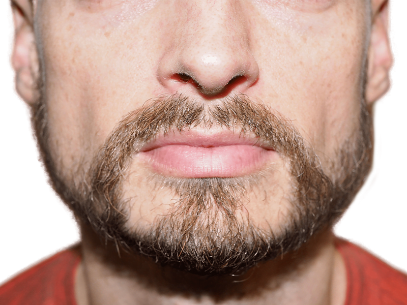 Man with full beard. Considering hair restoration? See beard density options & transplant results. Before & after consultation available.
